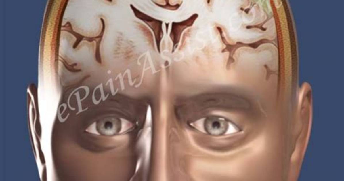 What Causes Subdural Empyemas?