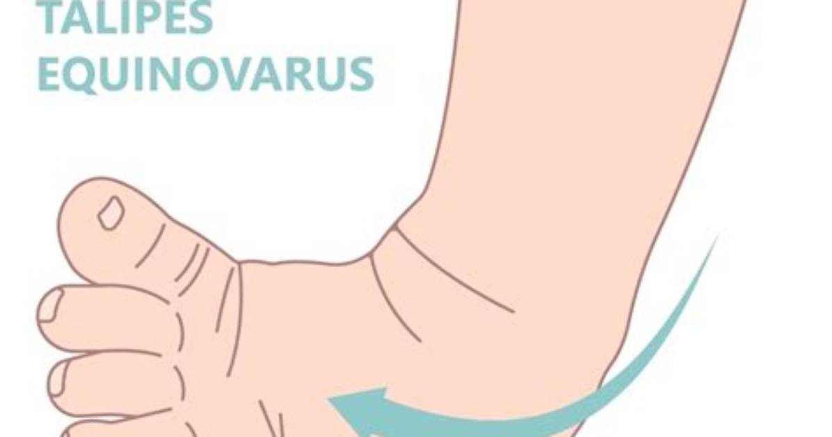 What Causes Talipes