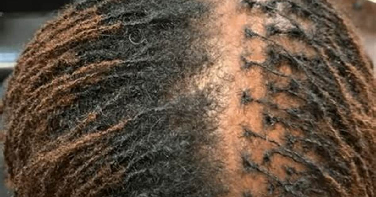 What Causes Thinning Locs?
