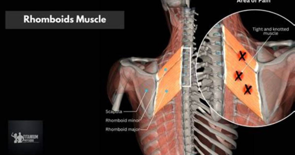What Causes Tight Rhomboids