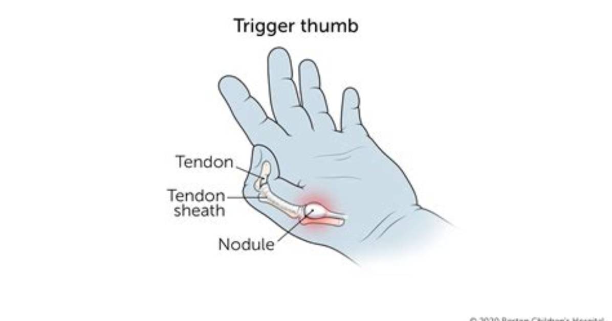 What Causes Trigger Thumb?