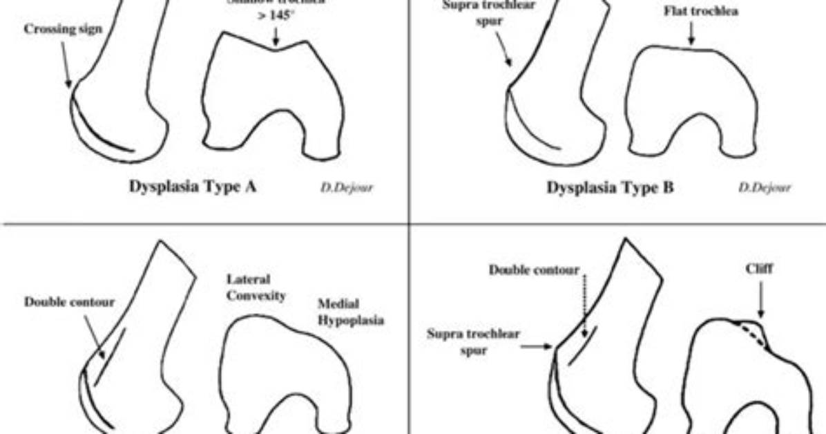 What Causes Trochlear Dysplasia