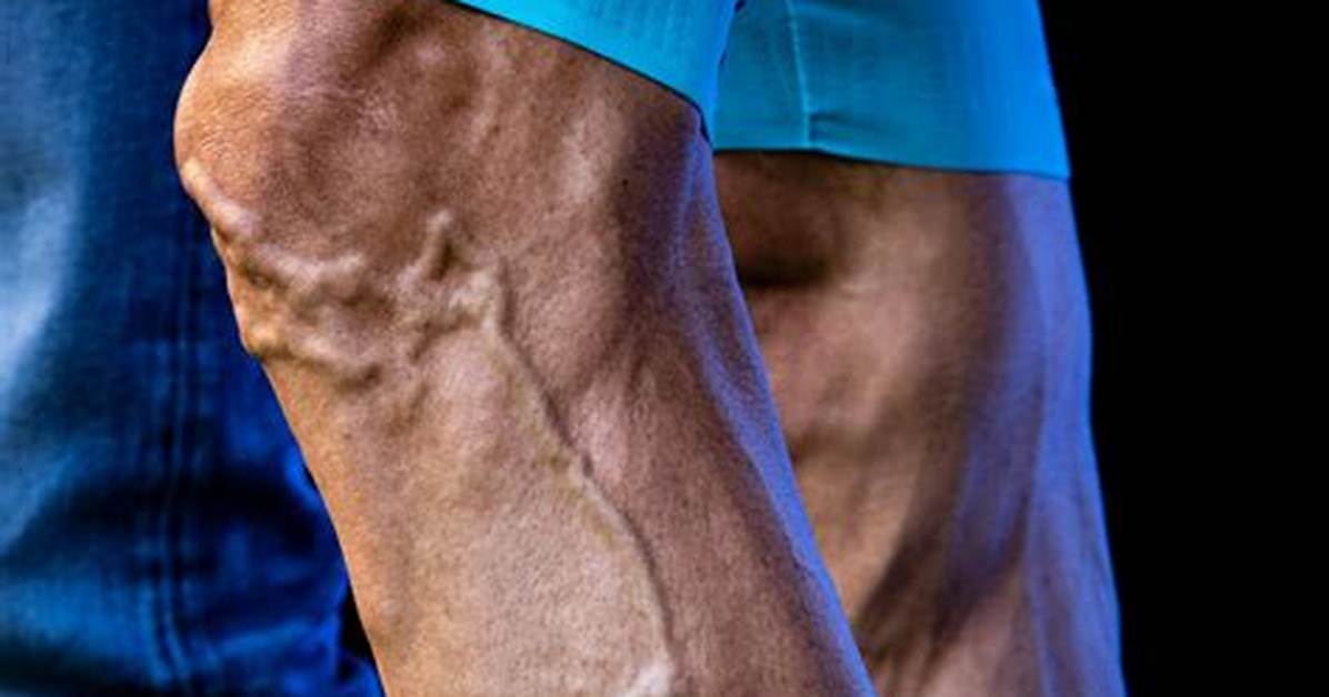 What Causes Veiny Legs?