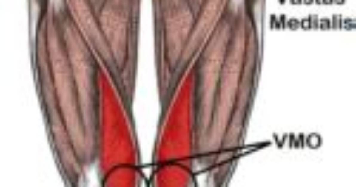 What Causes Vmo Weakness