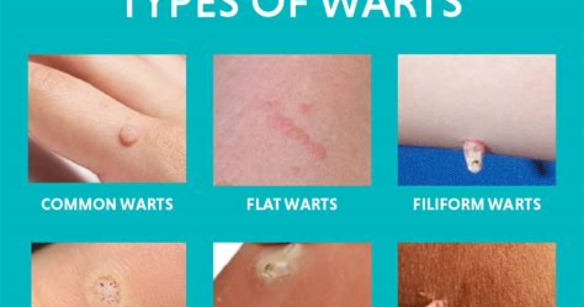 What Causes Warts on Sheep