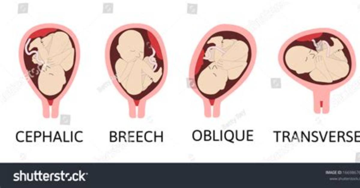 What Cephalic Means