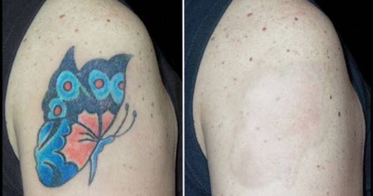 What Color Tattoo Cannot Be Removed?