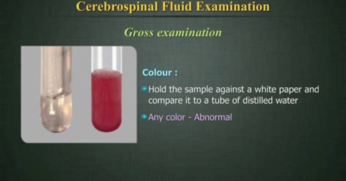 What Colour Is Csf Fluid
