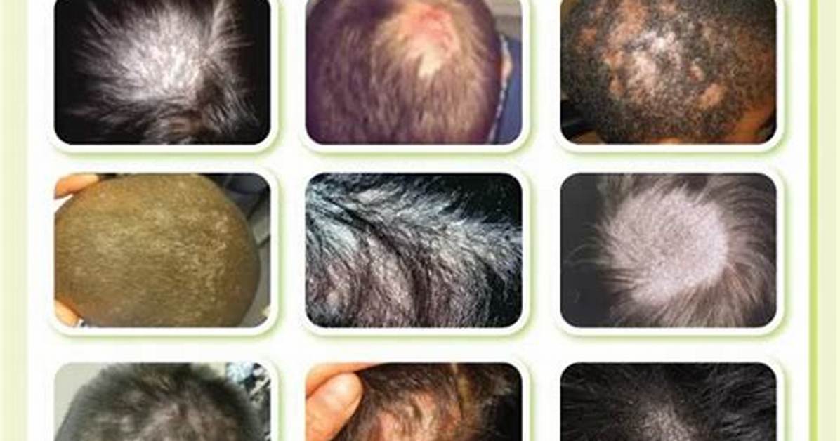 What Cures Tinea Capitis