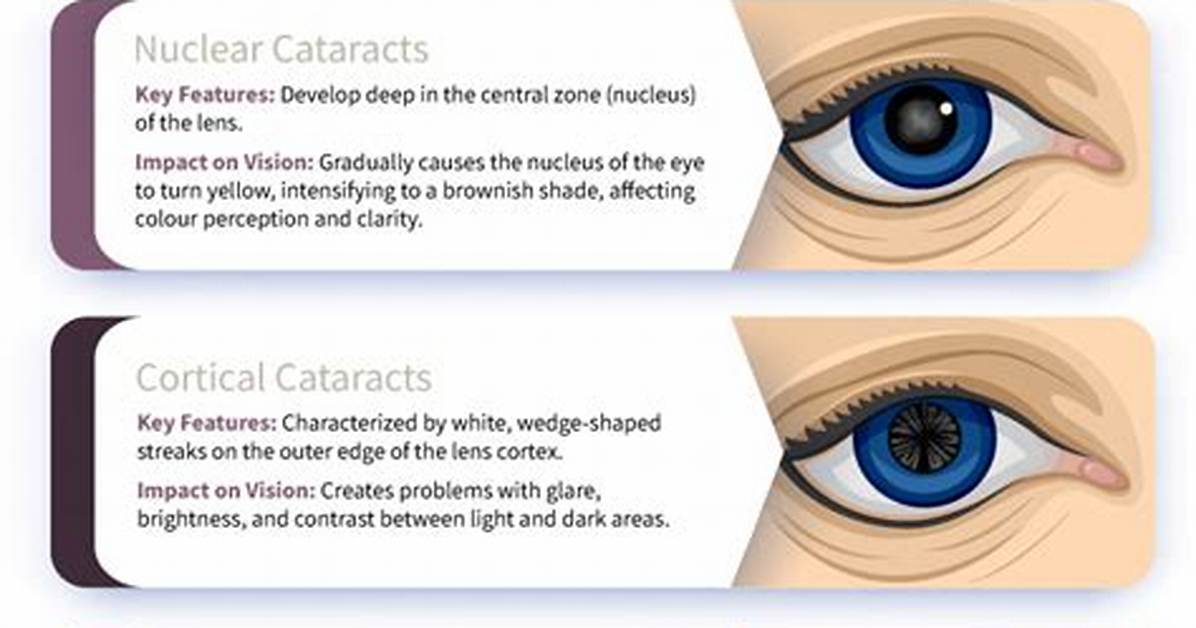What Do Cataracts Look Like?