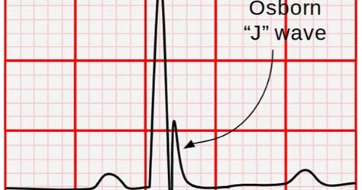 What Do Osborn Waves Mean