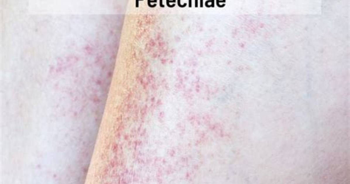 What Do Petechiae Look Like?