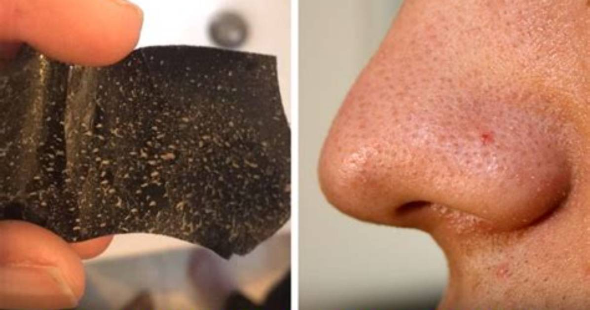 What Do Pore Strips Pull out?