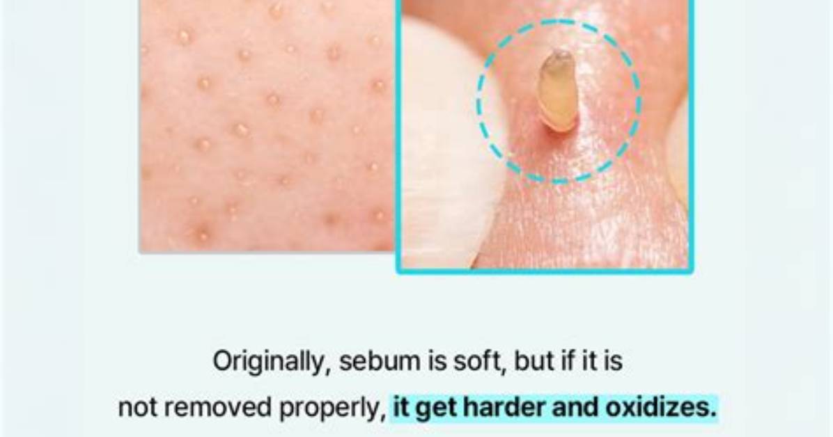 What Do Sebum Plugs Look Like