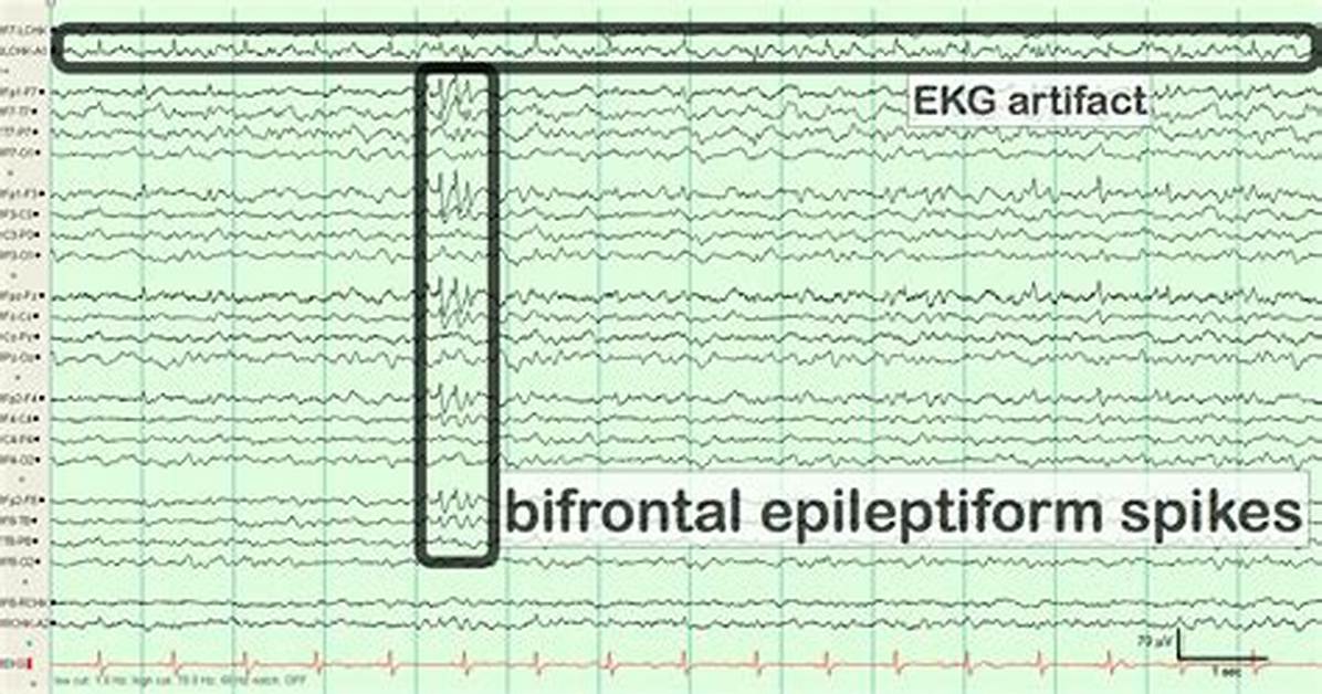 What Do Spikes on Eeg Mean