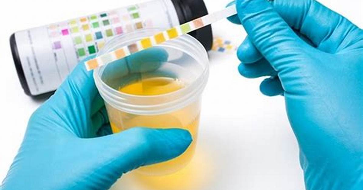 What Do Urinalysis Test for?