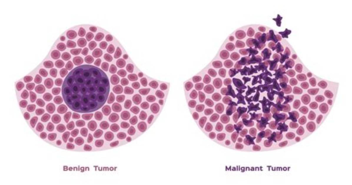 What Does a Creep Tumor Do?