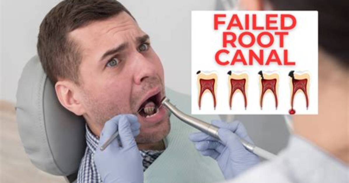 What Does a Failed Root Canal Feel Like?