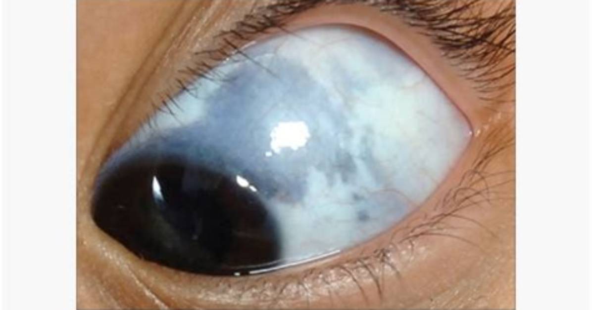 What Does a Grey Spot on Your Gums Mean?