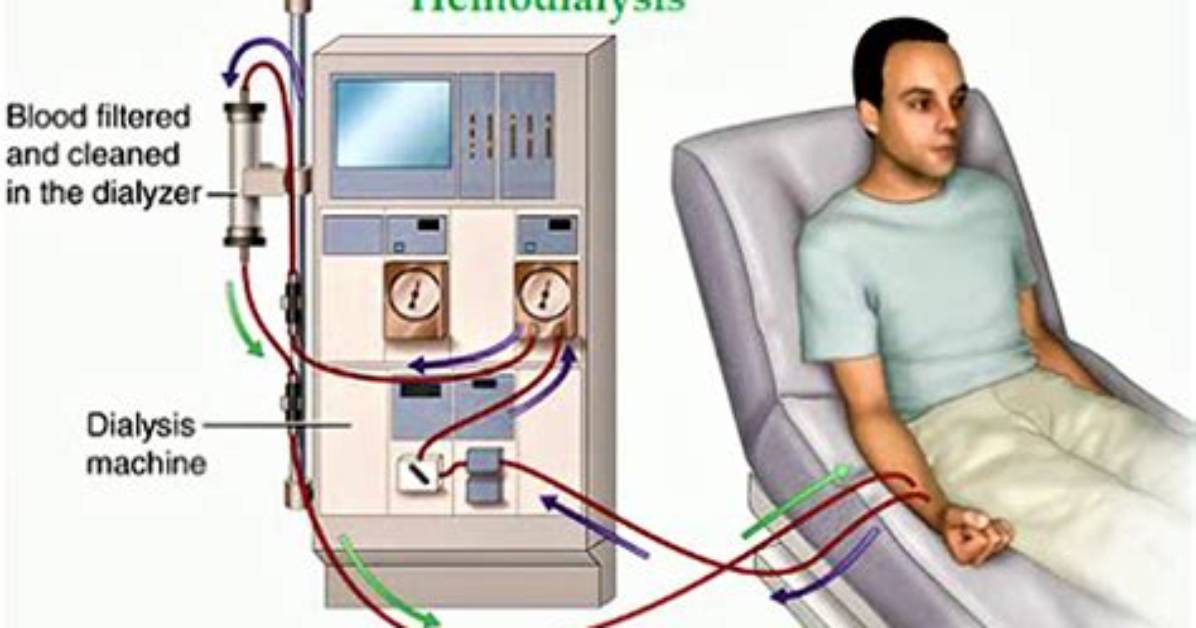 What Does a Hemodialysis Do?