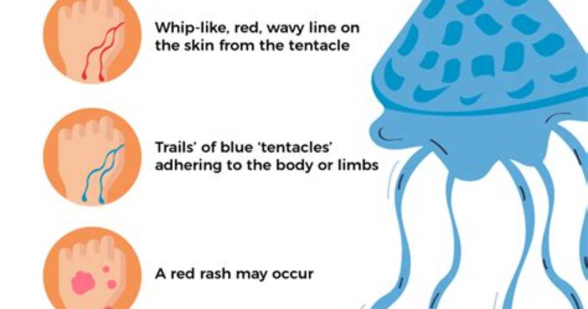 What Does a Jellyfish Sting Look Like?