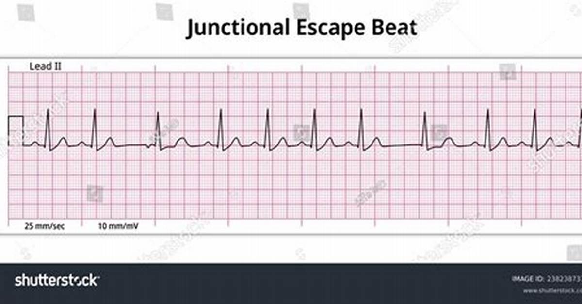 What Does a Junctional Escape Rhythm Look Like