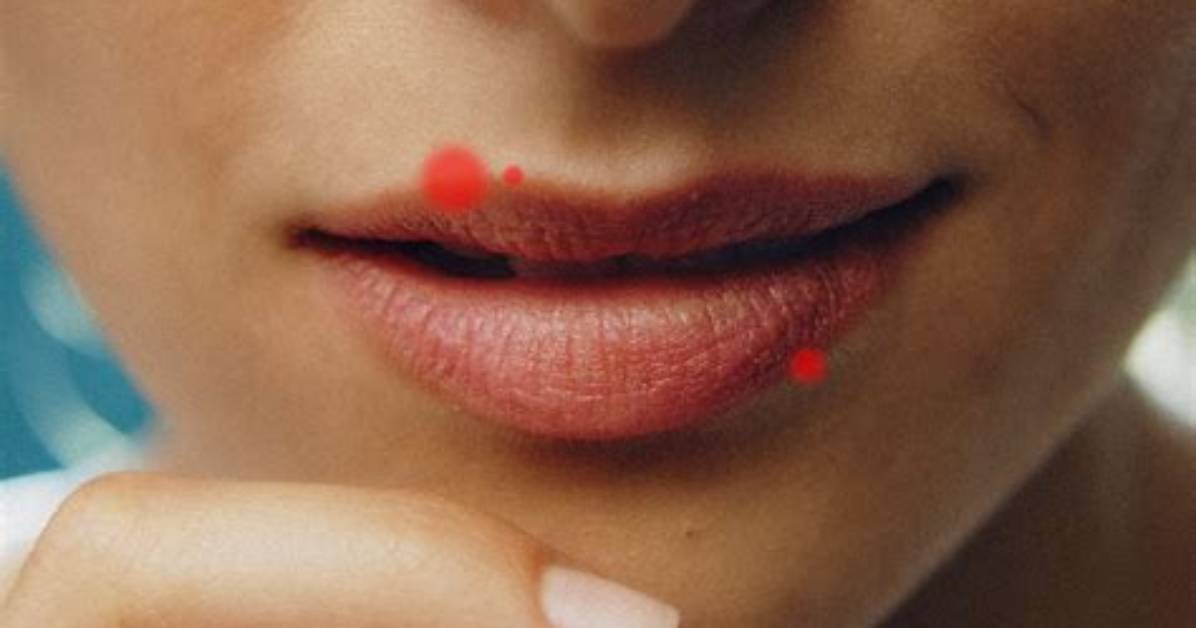 What Does a Love Pimple Mean?