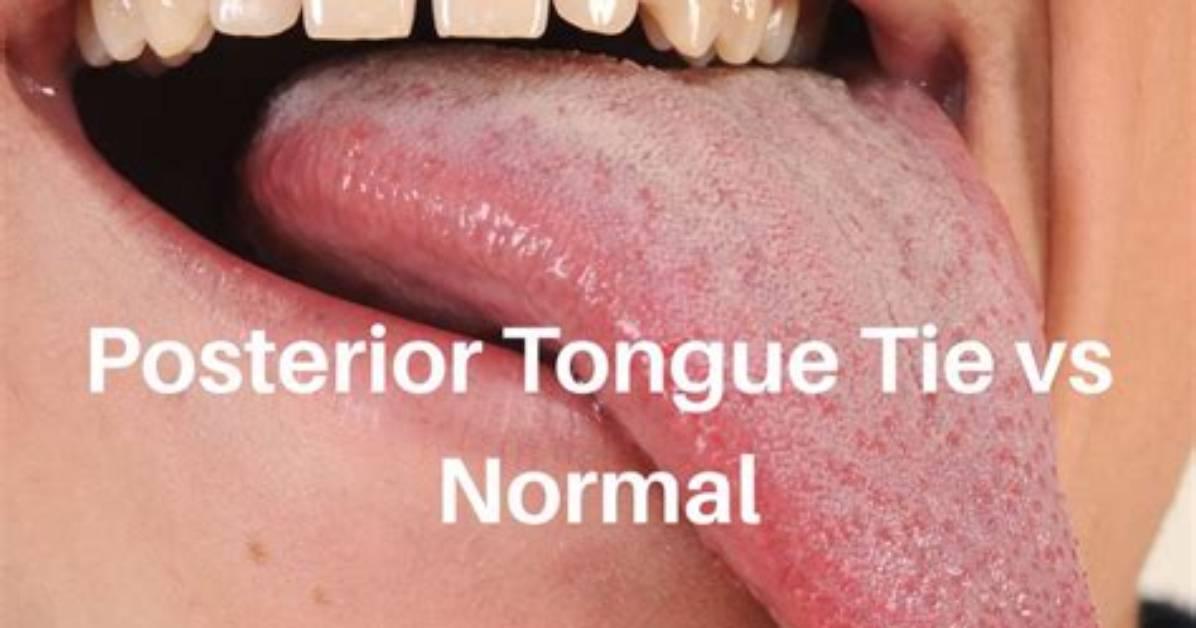 What Does a Normal Tongue-Tie Look Like?