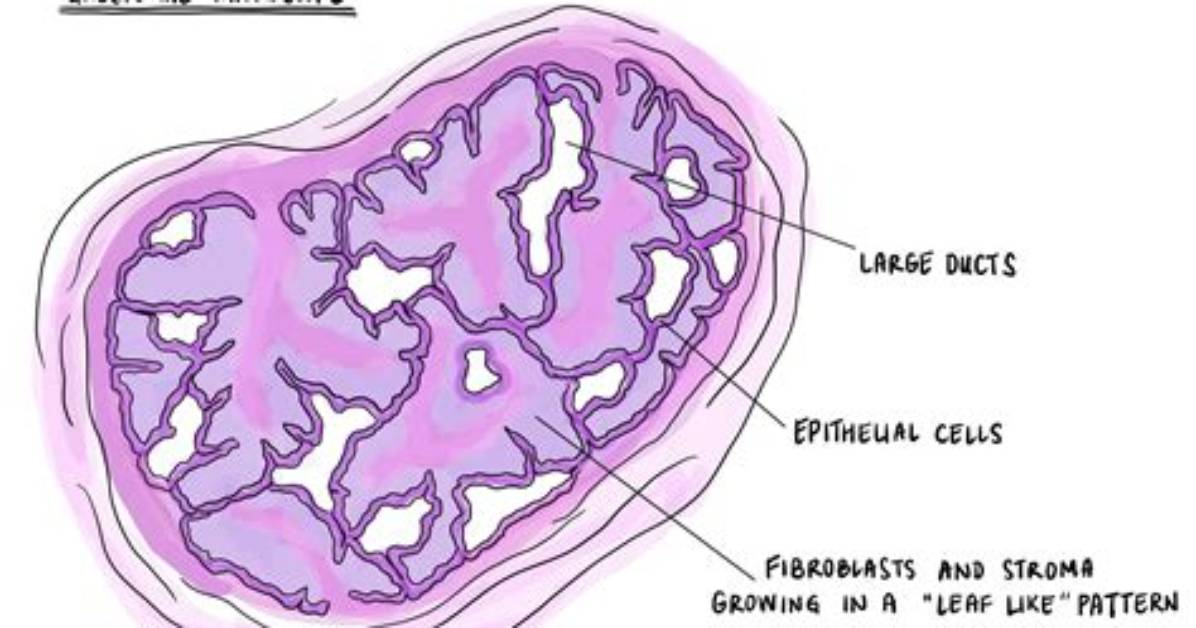 What Does a Phyllodes Tumor Look Like