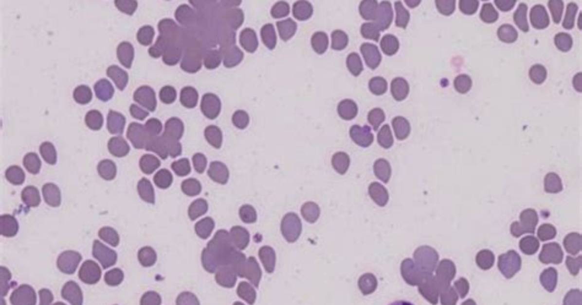 What Does a Positive Cold Agglutinin Test Mean
