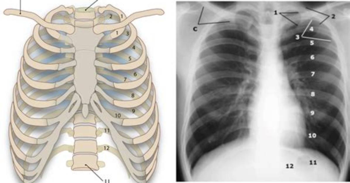 What Does a Rib X Ray Show