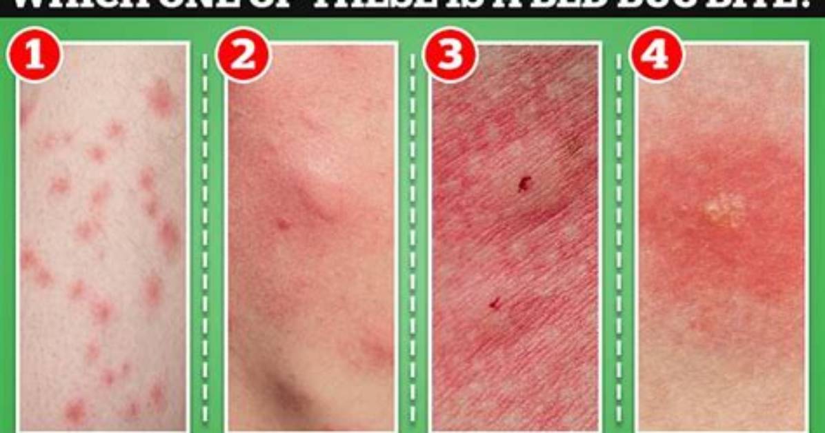 What Does a Single Bedbug Bite Look Like?