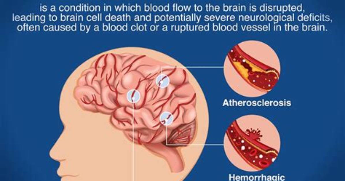 What Does a Stroke in Your Sleep Feel Like?