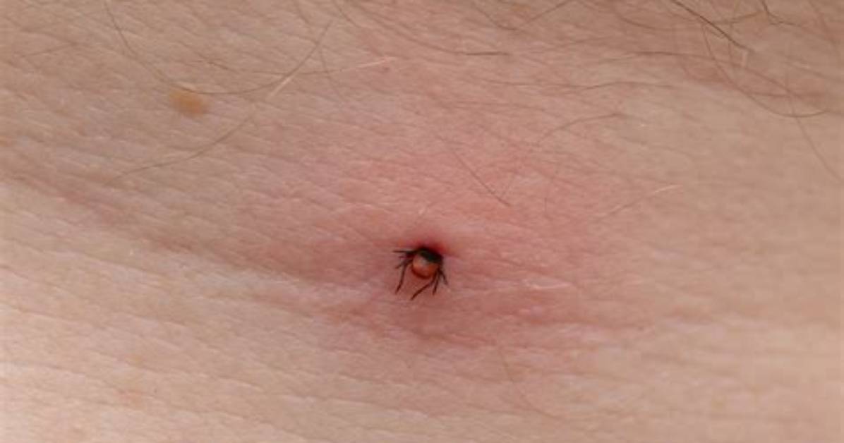 What Does a Tick Bite Look Like on a Human