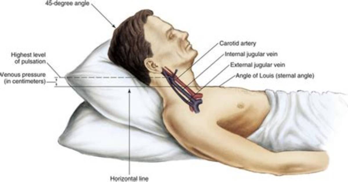 What Does Bilateral Jvd Indicate
