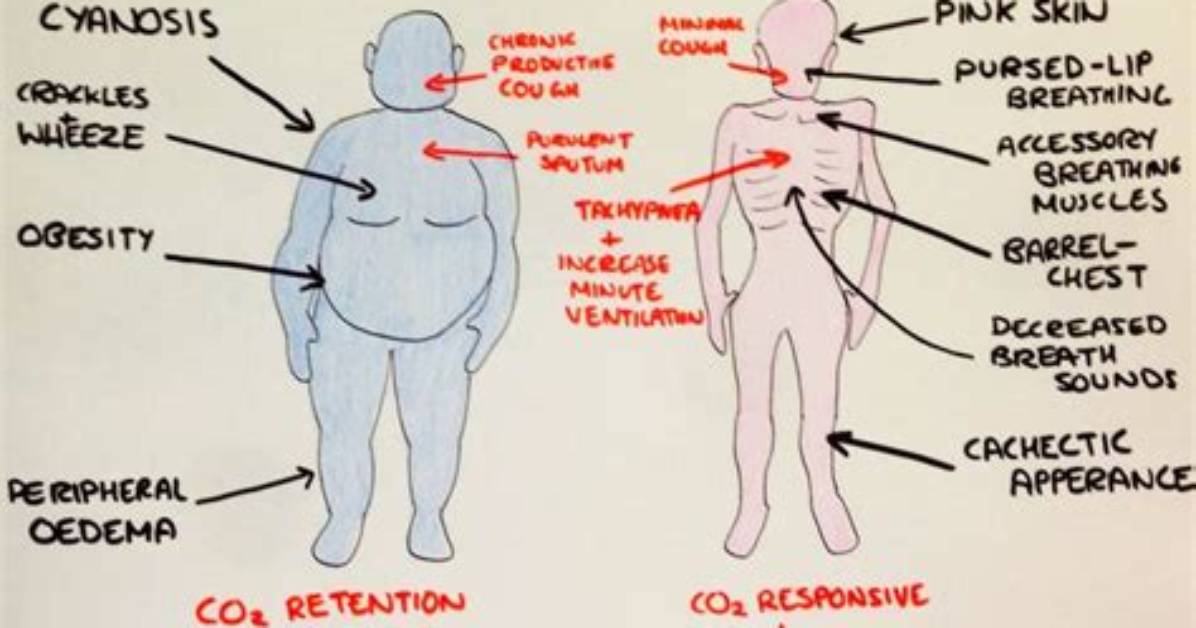 What Does Blue Bloater Mean