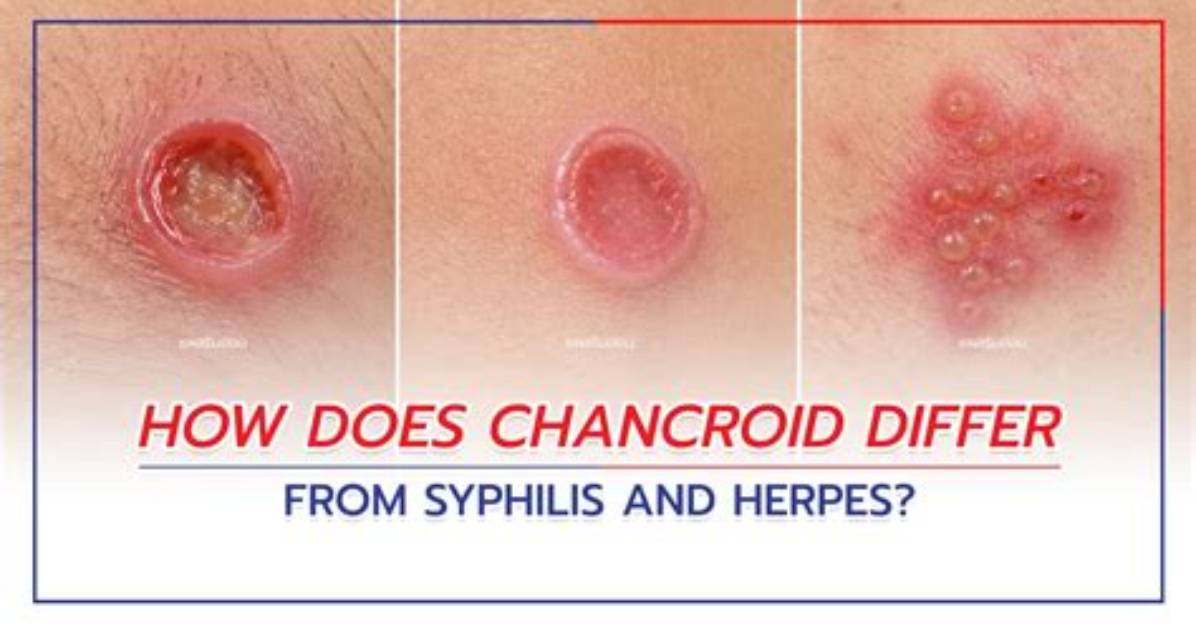 What Does Chancroid Mean?