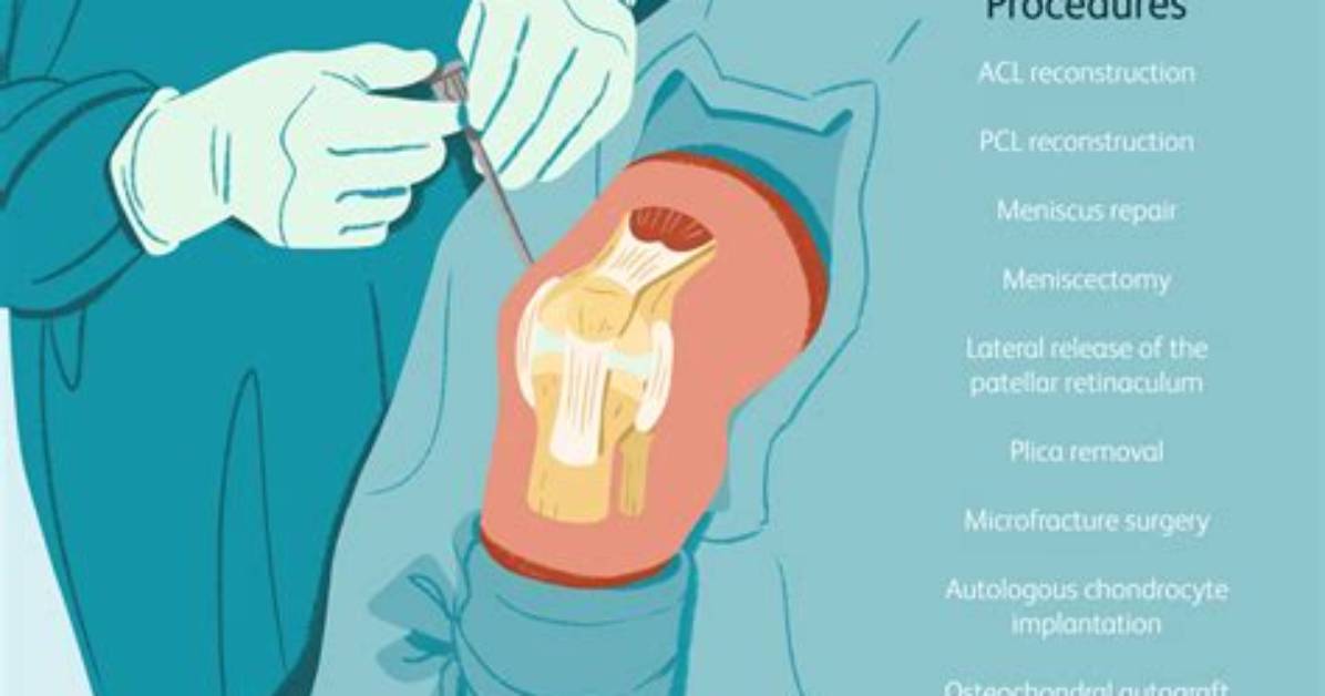 What Does Chondroplasty Mean?