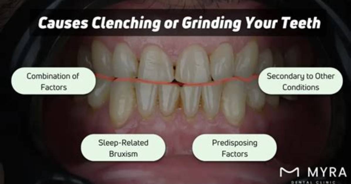 What Does Clenching Your Teeth Mean?