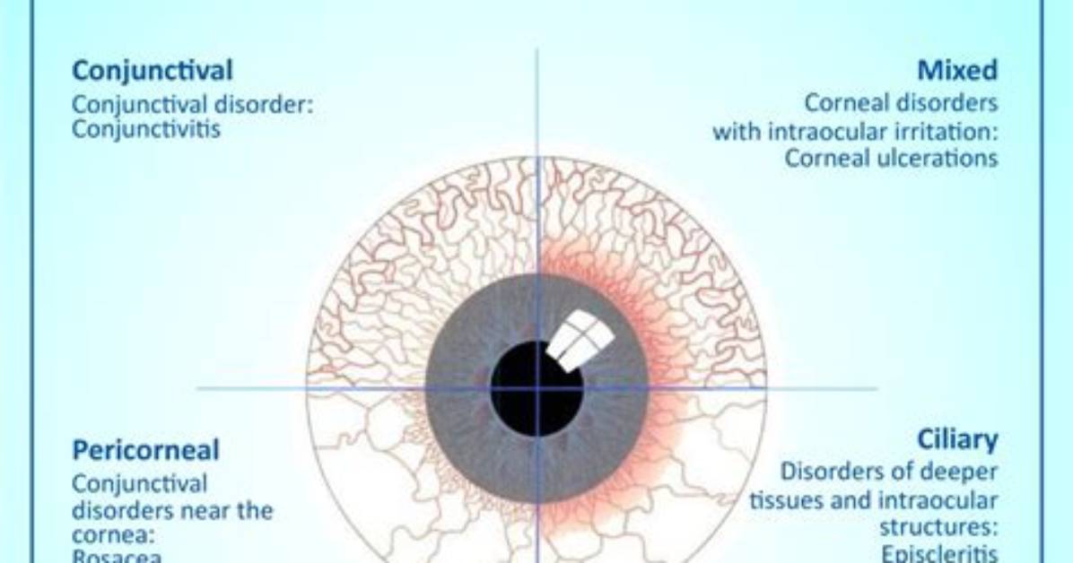 What Does Conjunctival Injection Mean