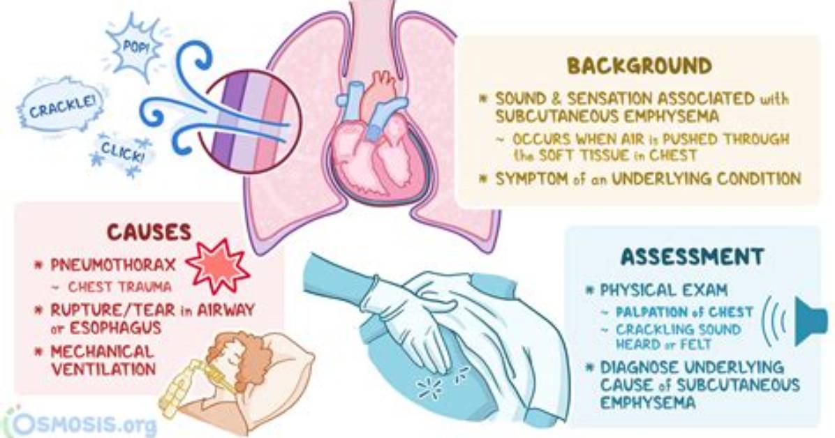 What Does Crepitation Indicate?