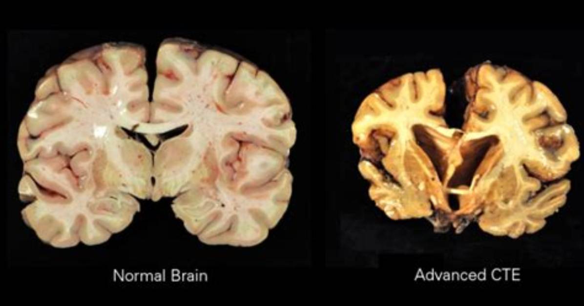 What Does Cte Means?