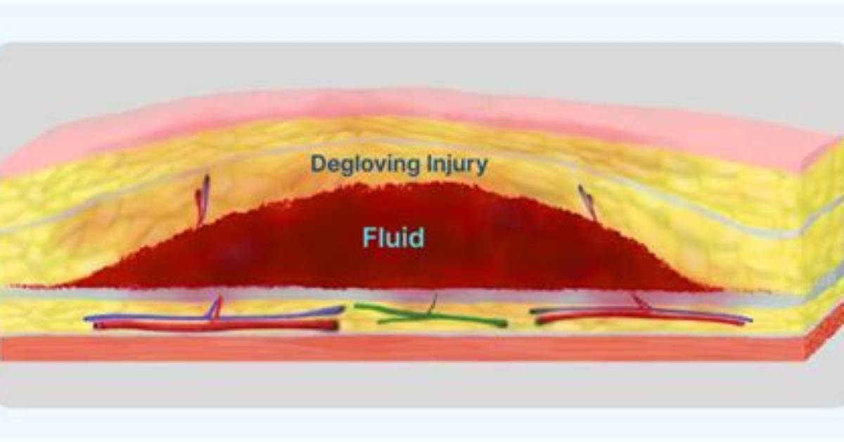 What Does Degloving Mean?