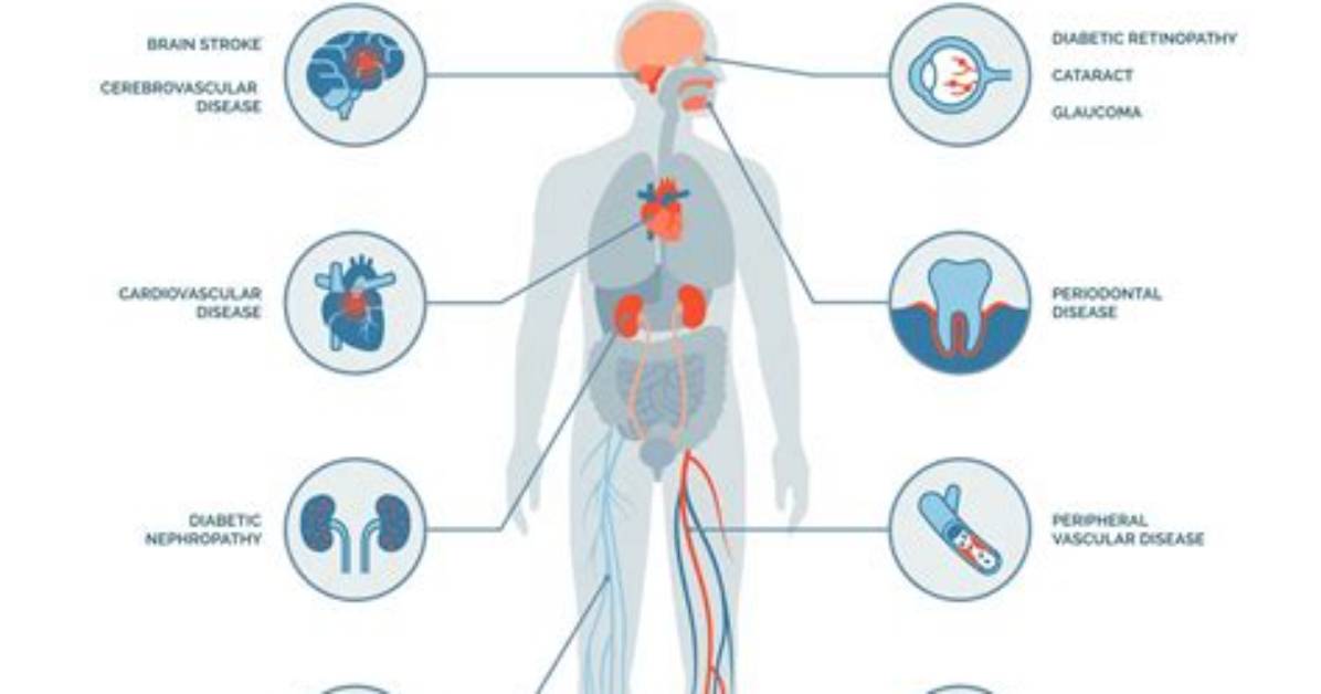 What Does Diabetes Do to Bones