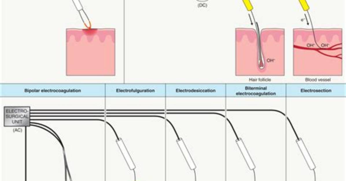 What Does Electrocauterization Do?