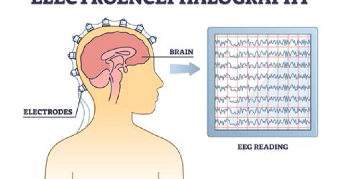 What Does Electroencephalographic Mean?