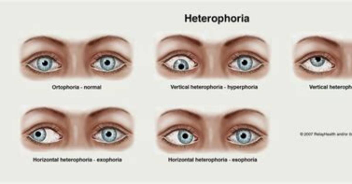 What Does Hyperphoria Mean? | Contextresponse. Com