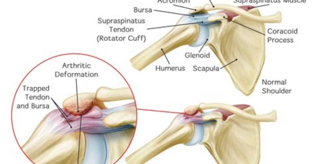 What Does Impingement Mean