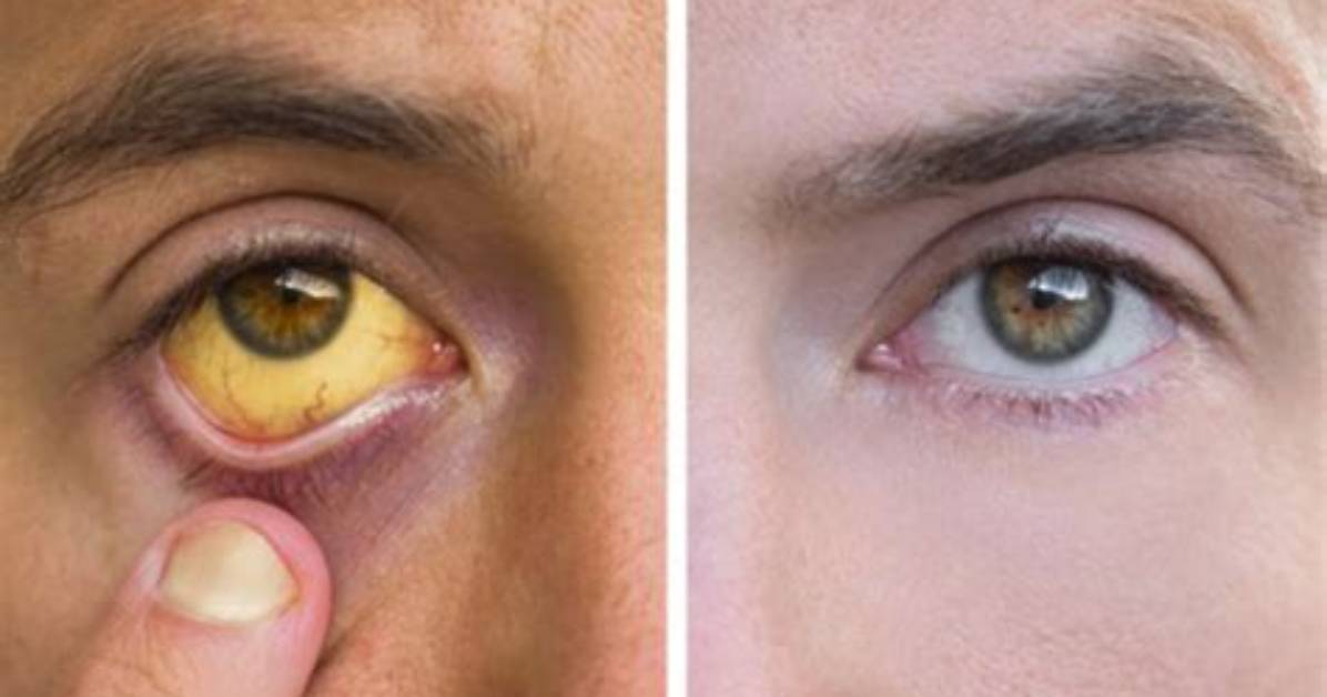 What Does Jaundice Indicate?