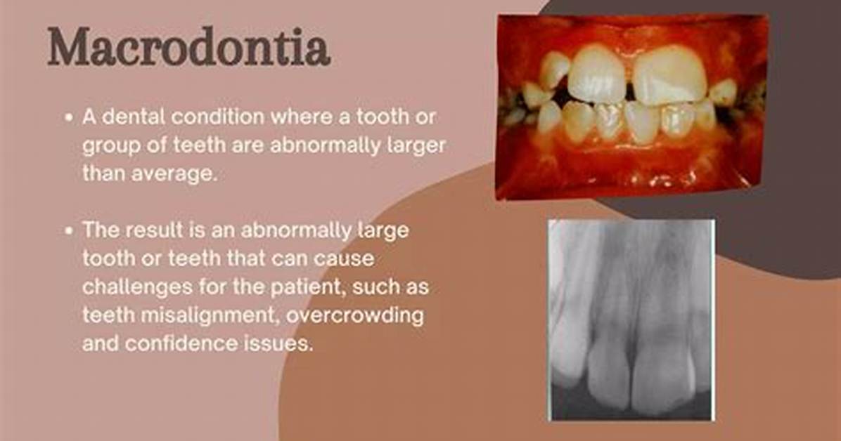 What Does Macrodontia Mean?